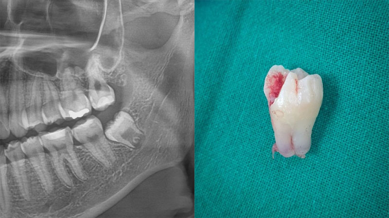 دندان عقل نهفته و نیمه نهفته (عکس و دانستنی ها) | دکتر برغمدی